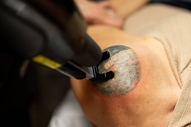 A laser handpiece treating a shoulder tattoo at Wichita Laser Clinic